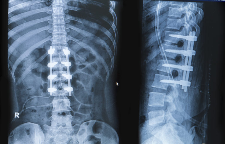 surgery spinal fusion