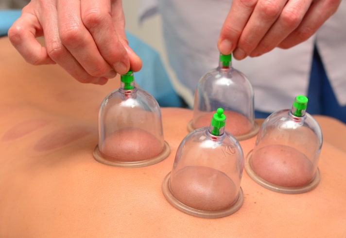 cupping therapy