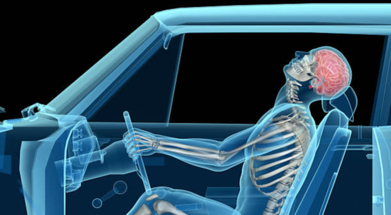 Whiplash injury