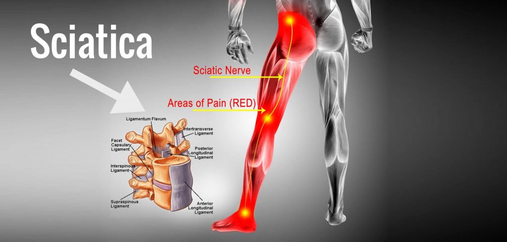 sciatica