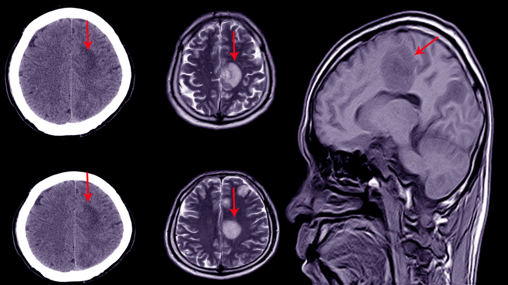 brain scan of concussion after traumatic brain injury in maryland