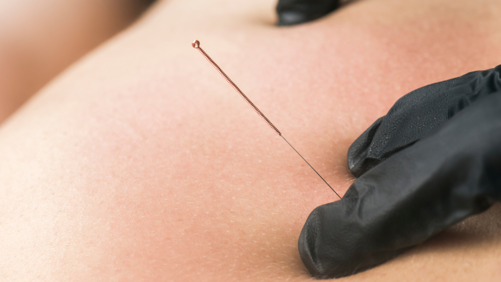 chiropractor performing dry needling on woman in her back at kaizo health in fairfax, va