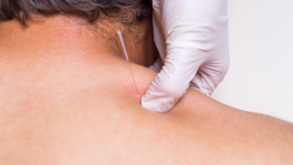 man getting dry needling in his right shoulder at kaizo health chiropractic office in landover, maryland