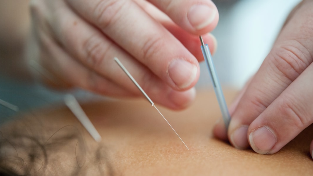 woman getting dry needling in her back at the chiropractor office in maryland
