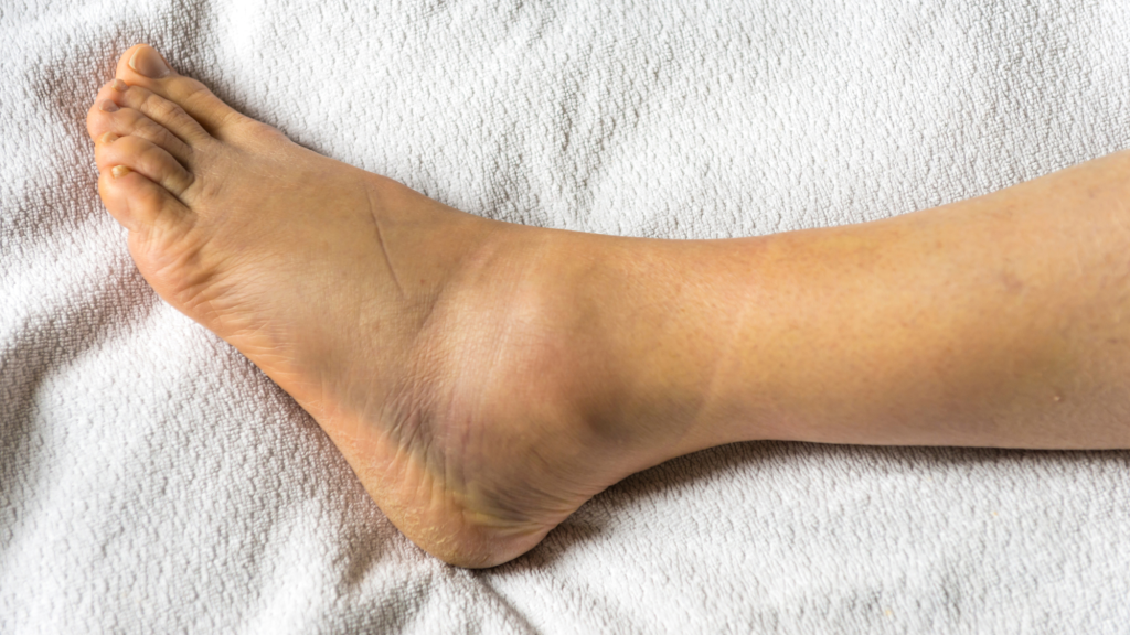 swollen left foot ankle from ankle sprain 