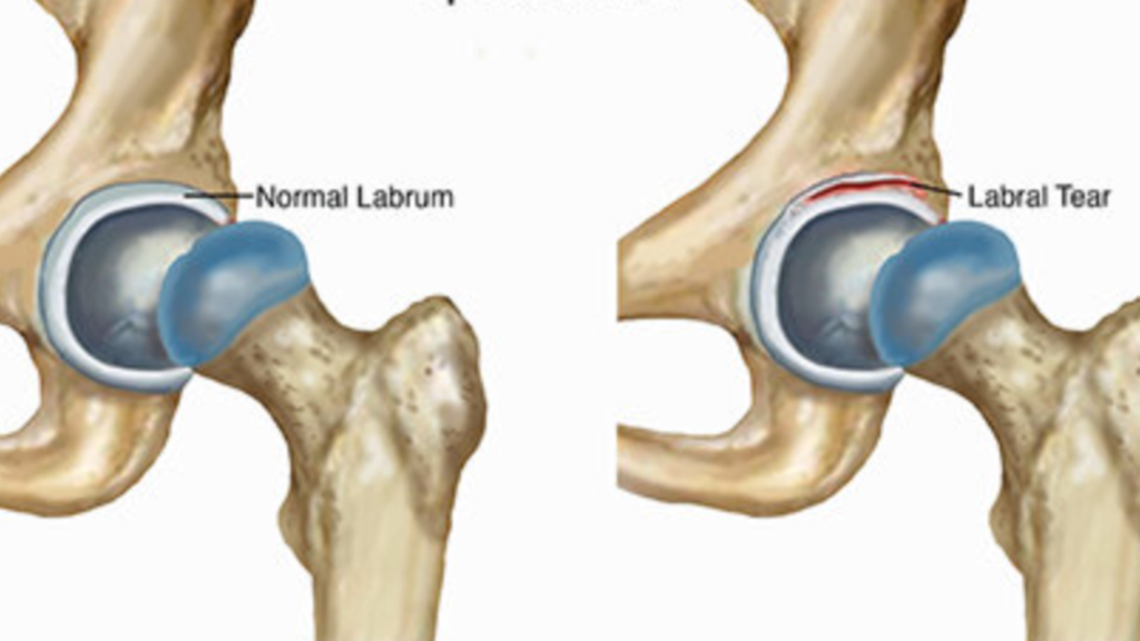 image showing a hip with and without labral tear in the joint