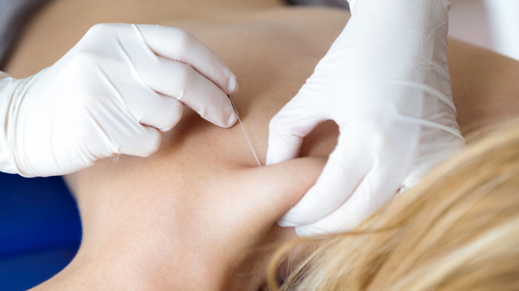 trigger point, dry needling