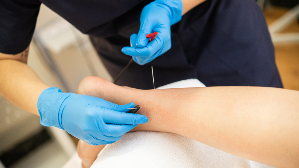 trigger point dry needling